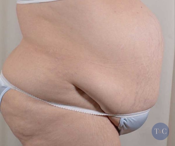 Tummy Tuck Actual Patient - Before