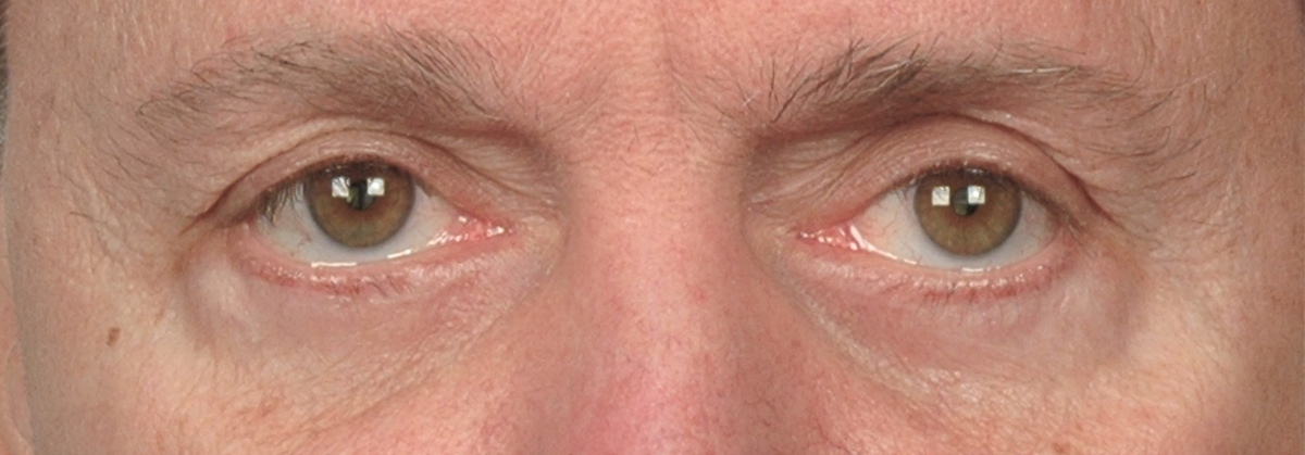 Eyelid Surgery Actual Patient - After