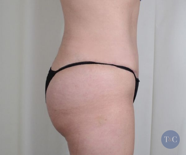 Brazilian Butt Lift Actual Patient - After