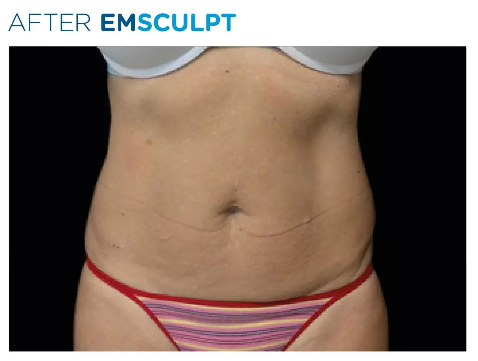 EMSCULPT® Body-Sculpting Treatment Actual Patient - After