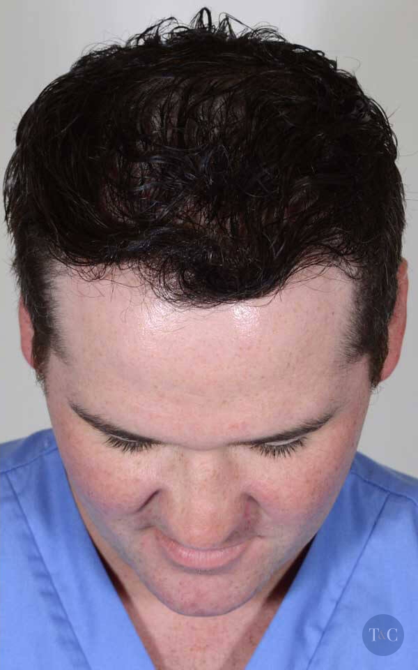NeoGraft® Hair Restoration Actual Patient - After