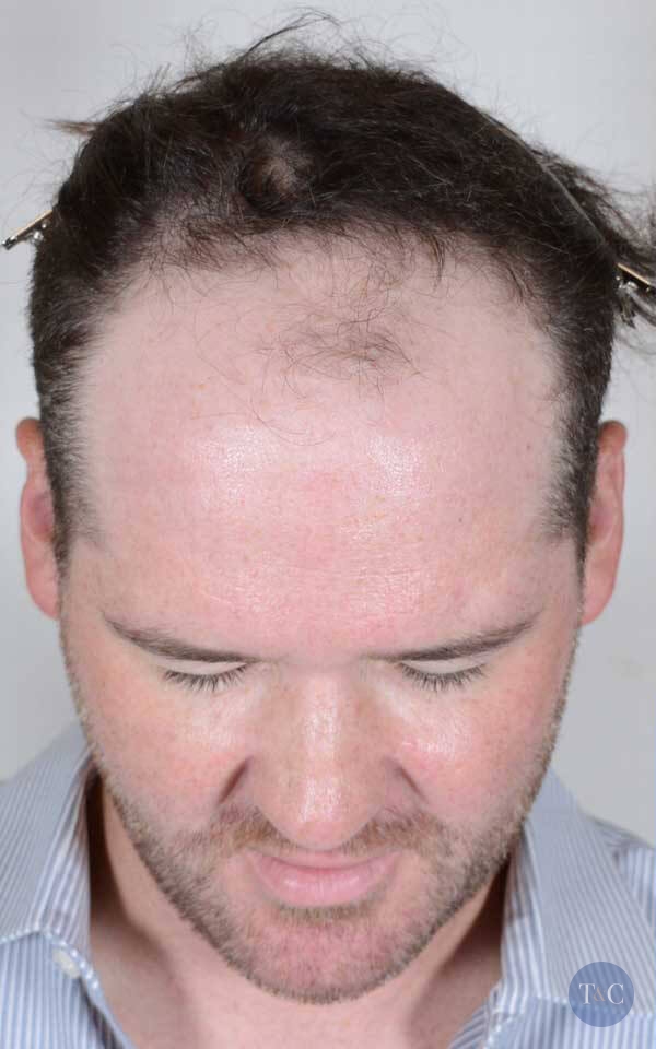 NeoGraft® Hair Restoration Actual Patient - Before