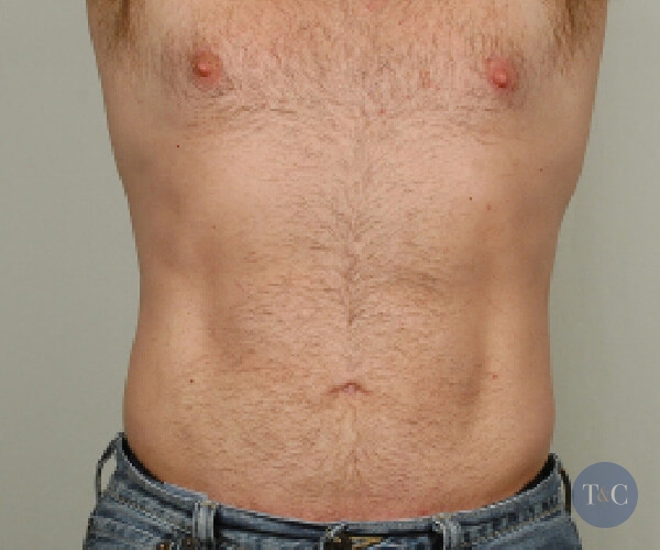 Liposuction For Men Actual Patient - After