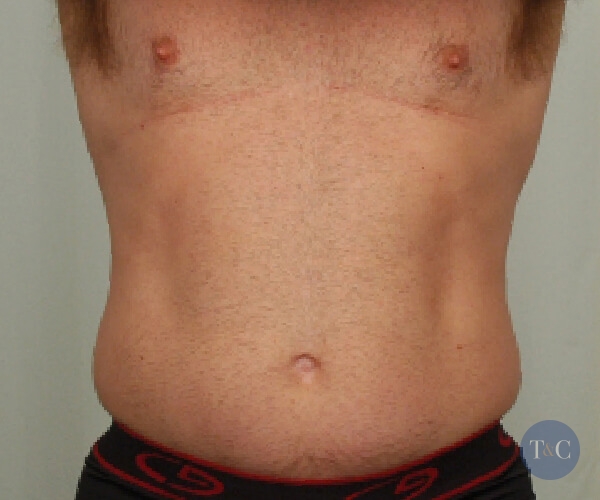 Liposuction For Men Actual Patient - Before