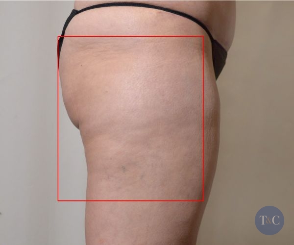 Cellulaze Treatment Actual Patient - After