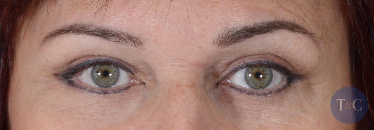 Eyelid Surgery Actual Patient - After