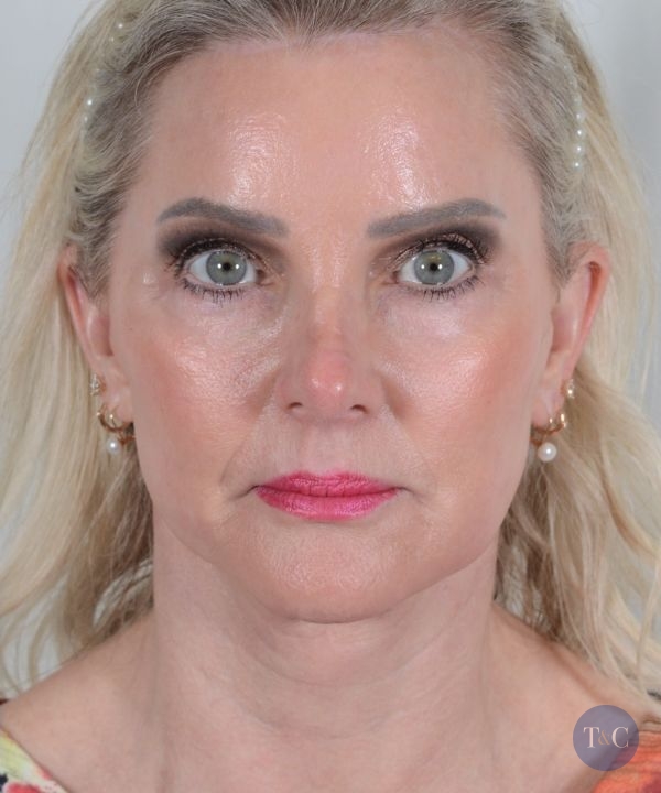 Facelift Actual Patient - After