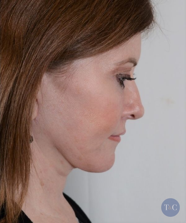 Neck Lift Actual Patient - After