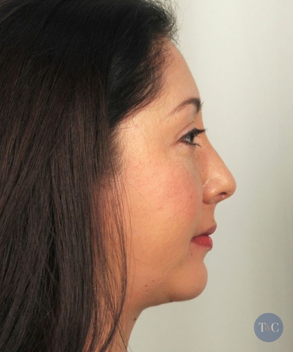 Facial Implants Actual Patient - After