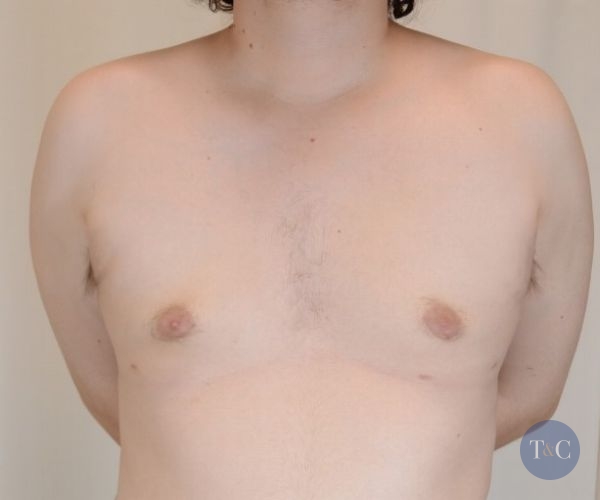 Gynecomastia Surgery Actual Patient - After