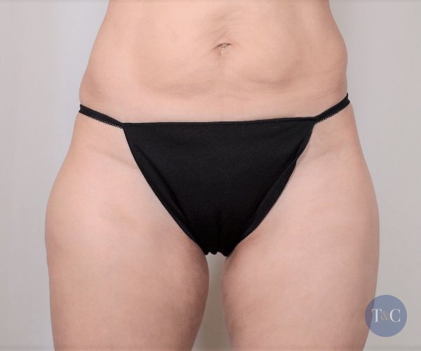 Liposuction Actual Patient - After