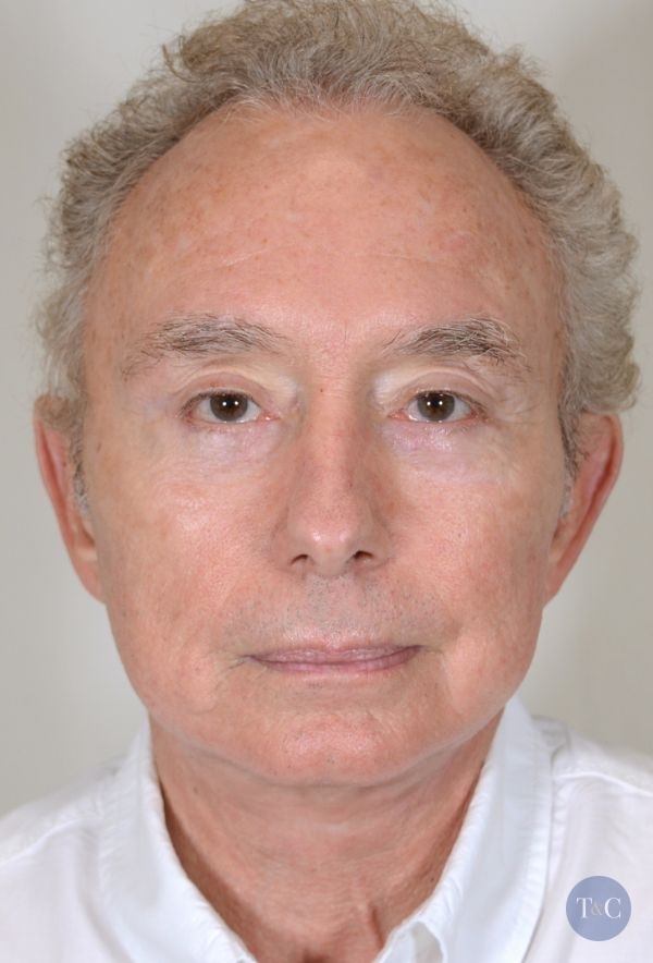 Facelift for Men Actual Patient - After