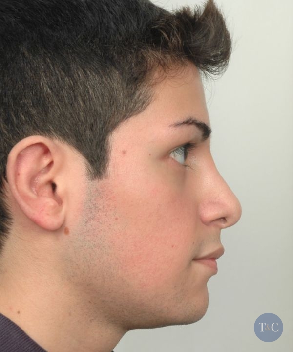 Rhinoplasty Actual Patient - After
