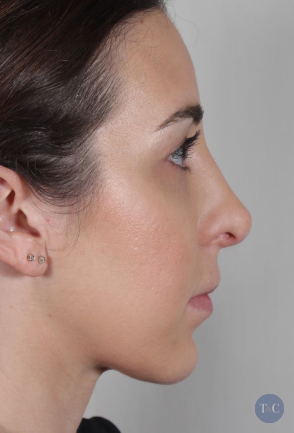 Rhinoplasty Actual Patient - After