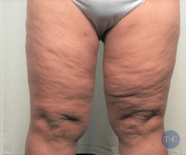 Thigh Lift Actual Patient - After