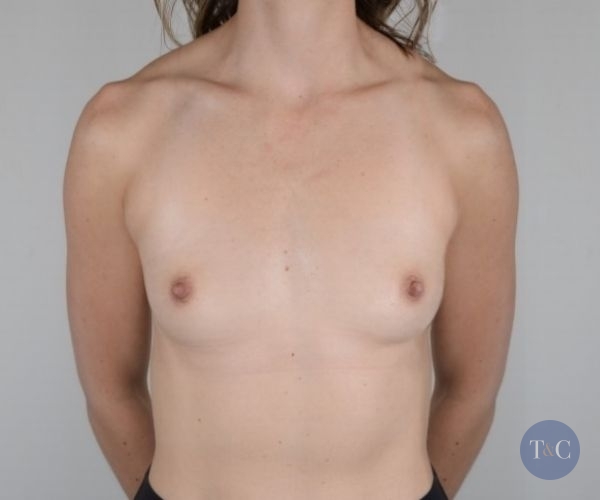 Breast Augmentation Actual Patient - Before