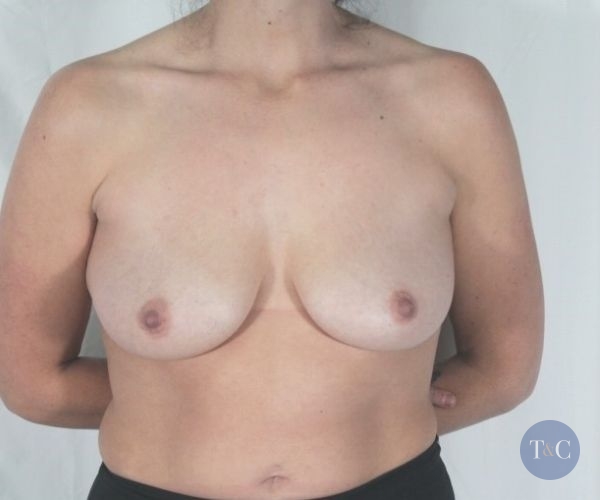 Breast Augmentation with Lift Actual Patient - Before