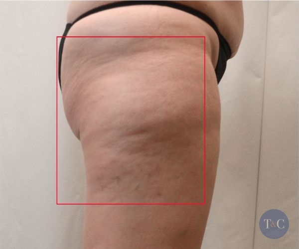 Cellulaze Treatment Actual Patient - Before