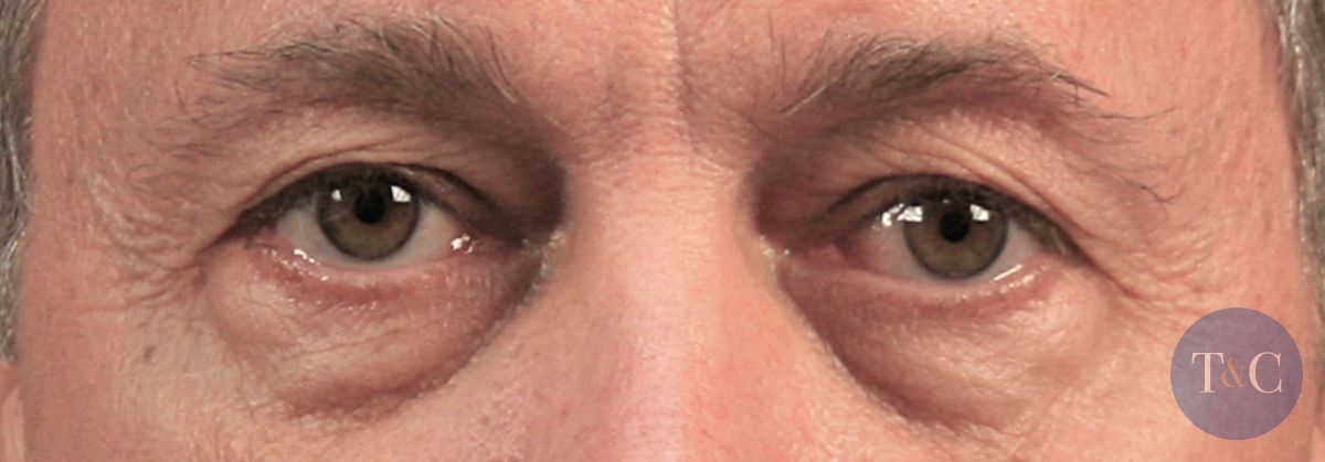 Eyelid Surgery Actual Patient - Before