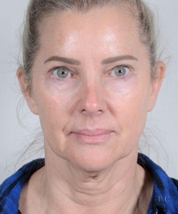 Facelift Actual Patient - Before