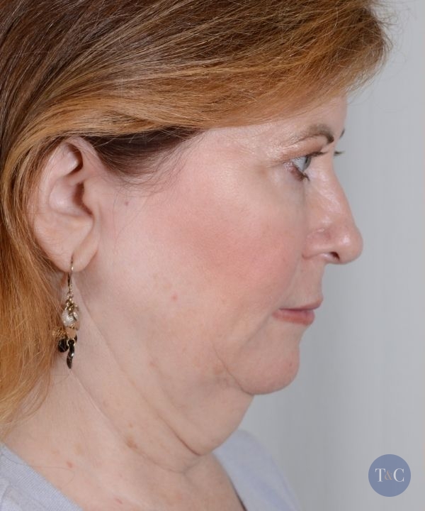 Neck Lift Actual Patient - Before