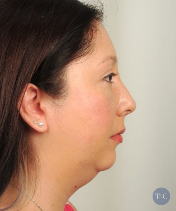 Facial Implants Actual Patient - Before