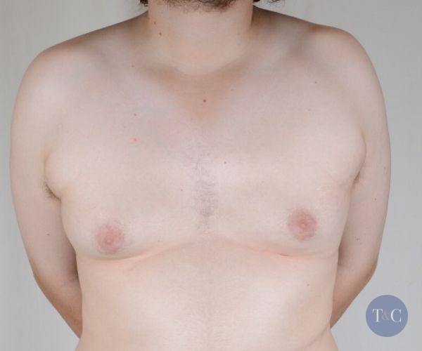 Gynecomastia Surgery Actual Patient - Before