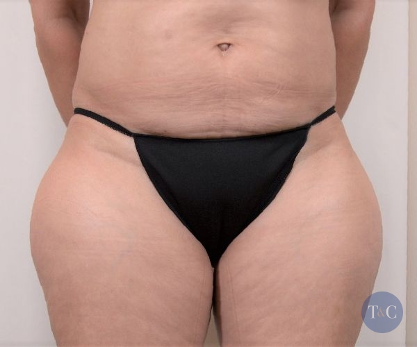 Liposuction Actual Patient - Before