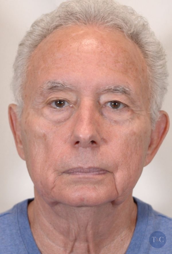 Facelift for Men Actual Patient - Before