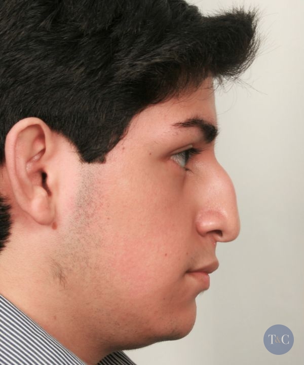 Rhinoplasty Actual Patient - Before