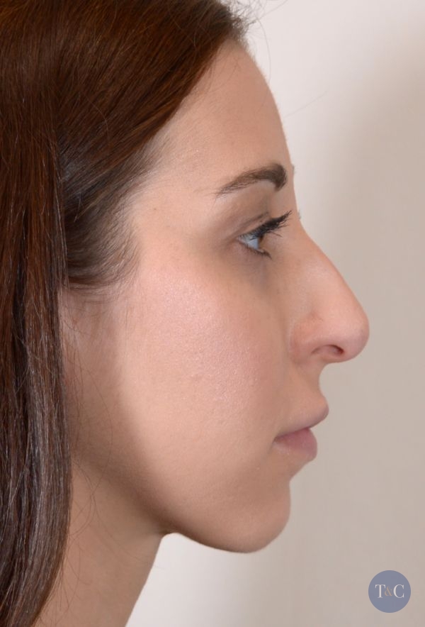 Rhinoplasty Actual Patient - Before