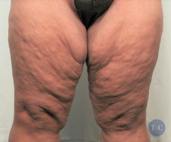 Thigh Lift Actual Patient - Before