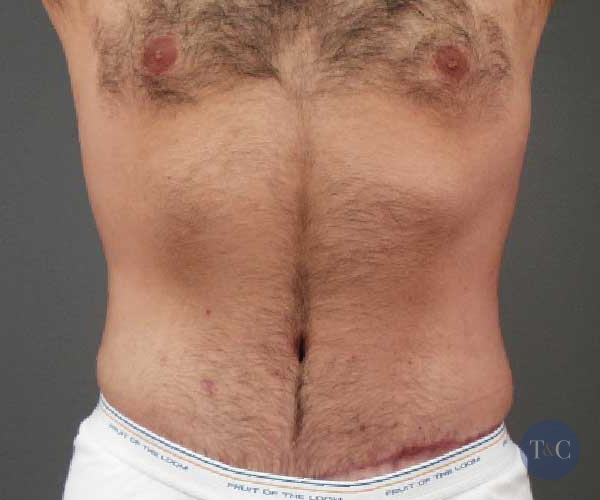 Tummy Tuck for Men Actual Patient - After