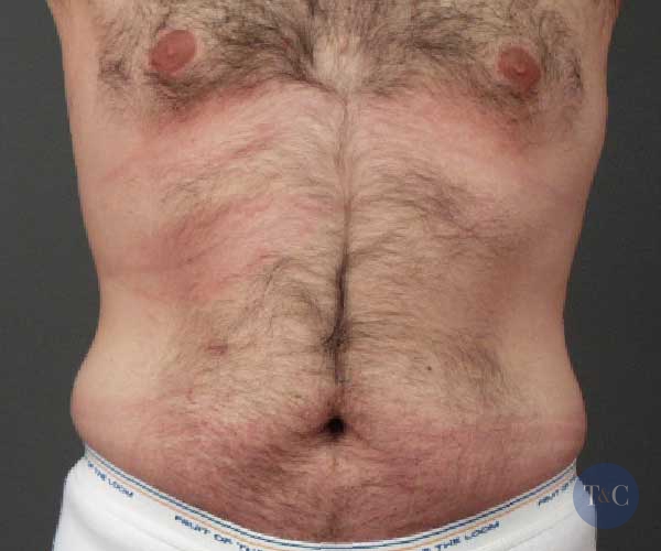 Tummy Tuck for Men Actual Patient - Before