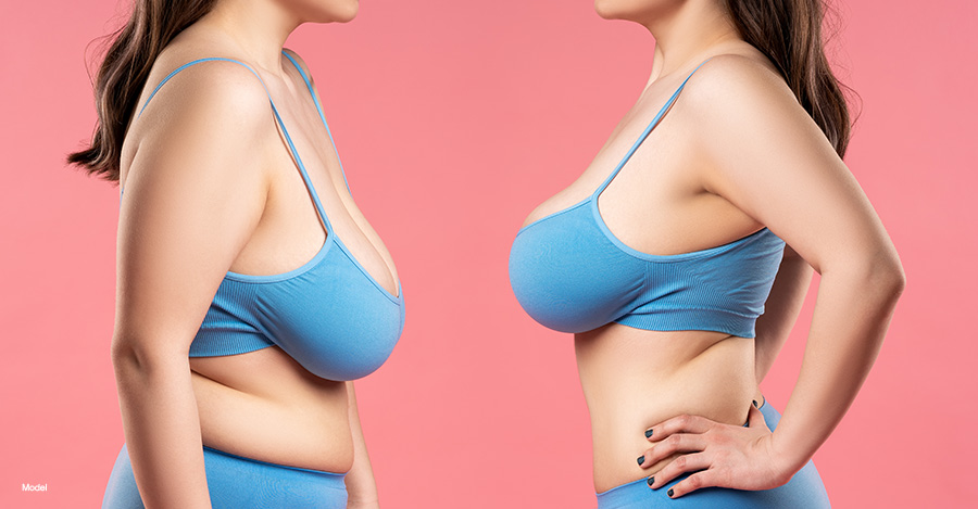 a woman in a blue bra, before and after breast augmentation