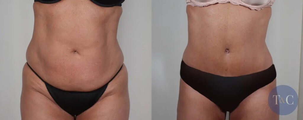 Before and after pictures of a tummy tuck patient