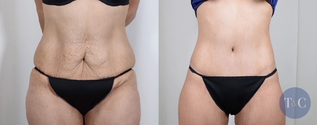 Before and after photos of a tummy tuck patient in Houston, Texas